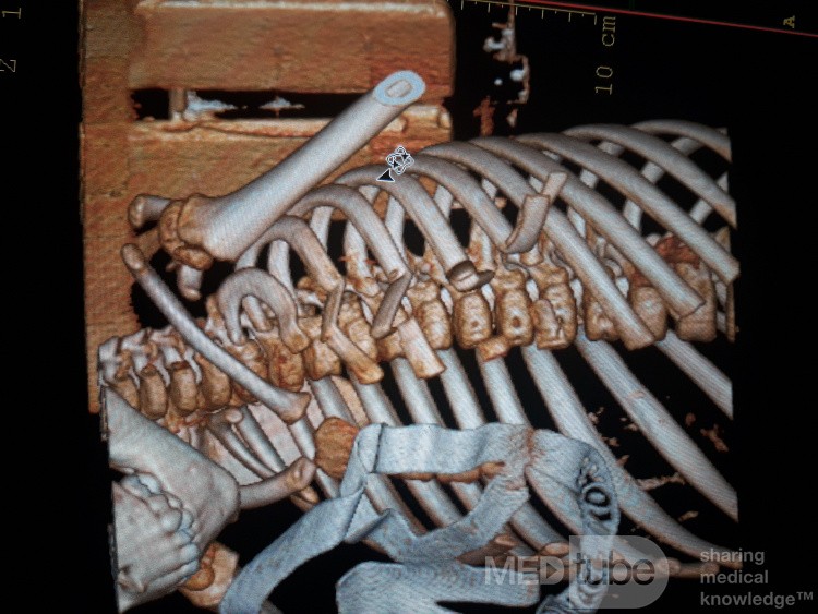 Multiple Ribs Fracture