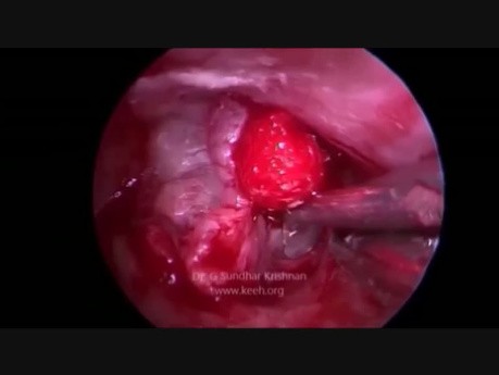 Endoscopic Transcanal Infracochlear Approach(Petrous Apex Granuloma)