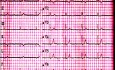 ECG Quiz 1.  An Electrocardiography Case. A Patient With Weakness and Dizziness
