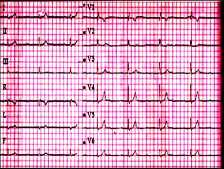 ECG Quiz 1.  An Electrocardiography Case. A Patient With Weakness and Dizziness