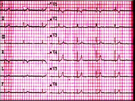 ECG Quiz 1.  An Electrocardiography Case. A Patient With Weakness and Dizziness