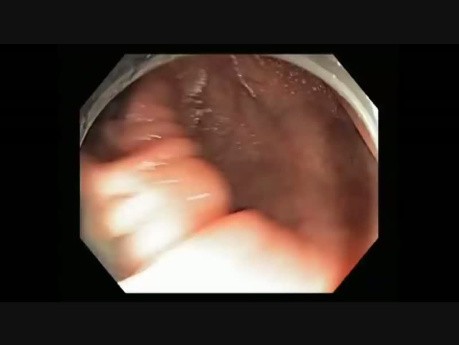Colonoscopy Channel Quiz 4