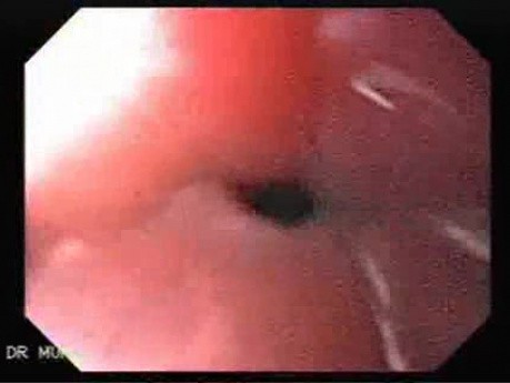 Esophageal Papilloma of the Lower Third  - Part 1