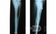 IM Interlocking nail of Tibia