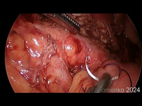 Laparoscopic Longitudinal Pancreatojejunostomy