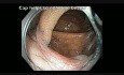 Ascending Colon - Scar After Endoscopic Mucosal Resection