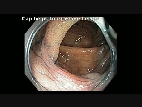 Ascending Colon - Scar After Endoscopic Mucosal Resection