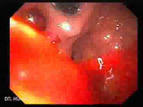 Upper Gastrointestinal Bleeding (1 of 3)