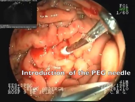 Percutaneous treatment of gastrostomy -EUS