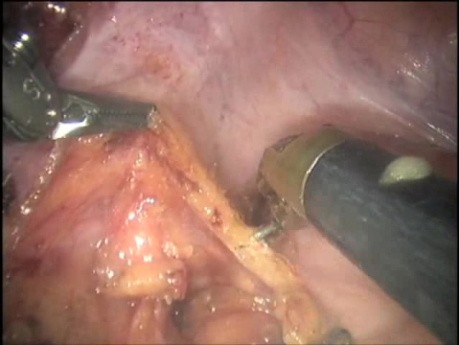 Robotic Total Mesorectal Excision - Marecik Et Al. 