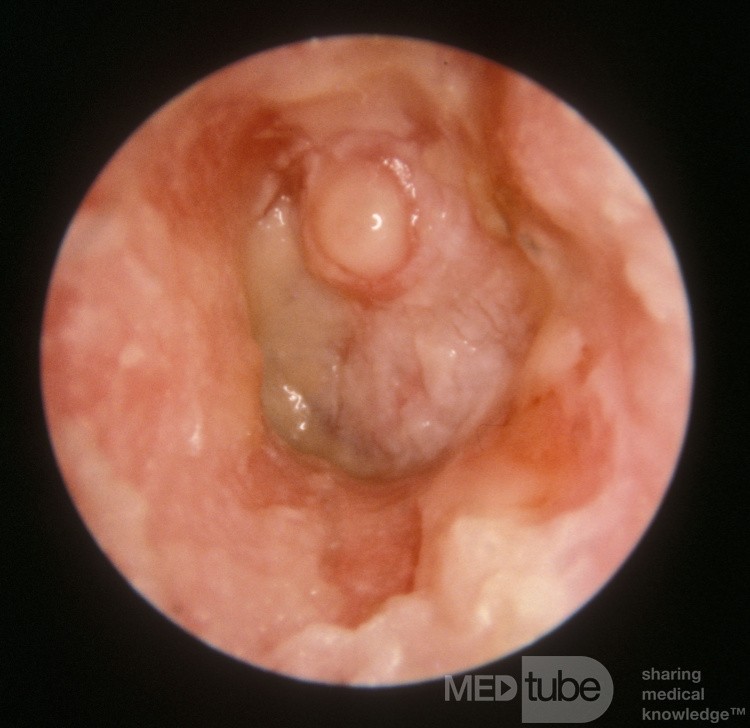 Severe Acute Otomycosis with Ulceration of the Canal Aspergillus Niger