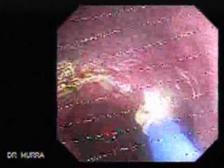 Barrett's Esophagus of long segment - Argon Plasma Coagulation 21/24