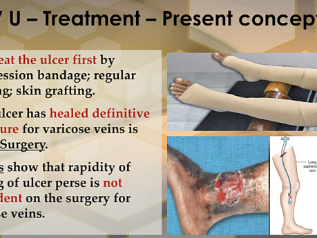 Venous Ulcer & Deep Vein Thrombosis