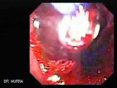 Esophageal Achalasia (8 of 10)