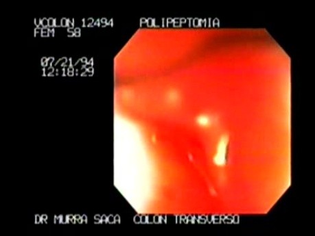 Endoscopic snare excision of large pediculated Polyp (3 of 5)