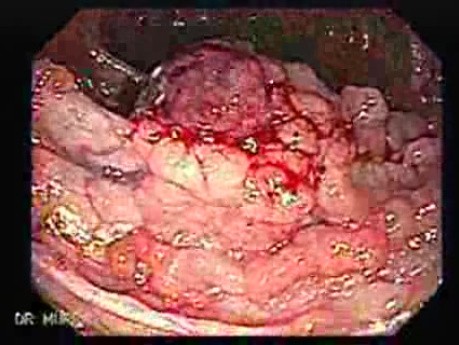 Familial Adenomatous Polyposis (15 of 36)