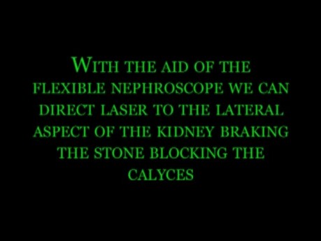 Percutaneous Nephrolithotripsy - Cystinuria