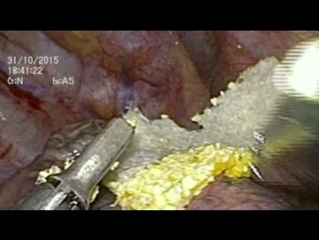 The Use of Tachosil® for Air Leak Repair in Upper Right Lobe Alveolar Fistula