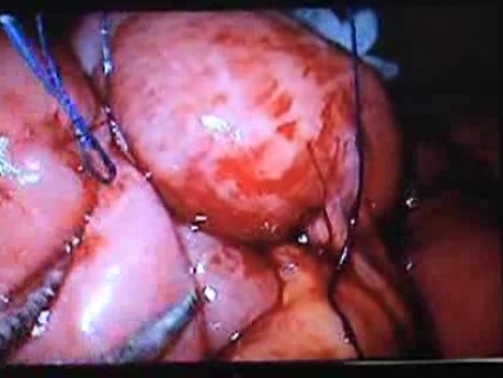 Jejunal Gastrointestinal Stromal tumor (GIST) (75 of 86)