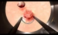 Bladder tumor Removal