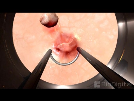 Bladder tumor Removal