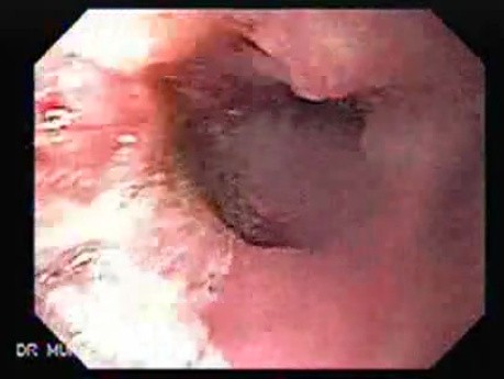 Esophageal Squamous Cell Carcinoma of the the upper third of the Esophagus (1 of 3 )