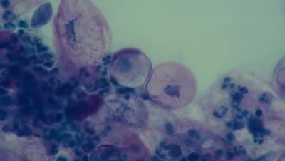 Menopause - Cell degeneration