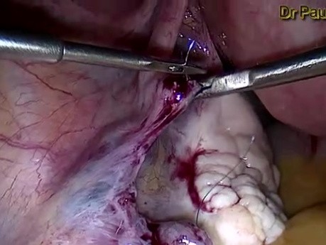 Creation of Tubotubal Anastomosis