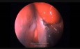 Endoscopic Excision of Juvenile Angiofibroma