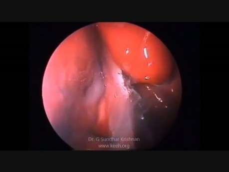 Endoscopic Excision of Juvenile Angiofibroma