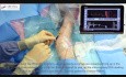 Venous Access Made Easy Video (7)