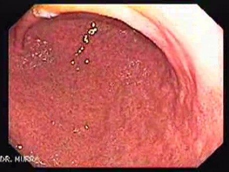 The Gastric Body - Normal Rugal Folds of the Gastric Body (2 of 6)