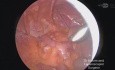 Left Inguinal Hernia with Diverticulosis of Sigmoid Colon