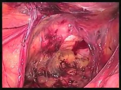 Inguinal Hernioplasty - SILS TAPP 