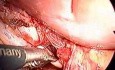 Cholecystectomy - single port access