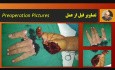 Replantation Case 1