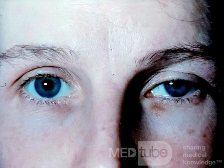 Horner's Syndrome [Left]