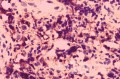 Non-Hodking Lymphoma B Cells. MALT (mucosa associated lymphoid tissue) (6 of 7)
