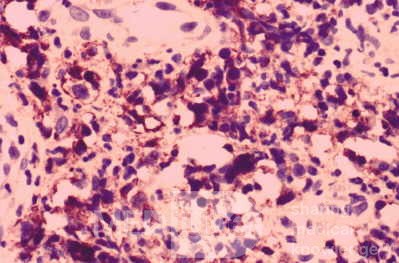 Non-Hodking Lymphoma B Cells. MALT (mucosa associated lymphoid tissue) (6 of 7)