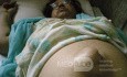 Large Umblical Hernia