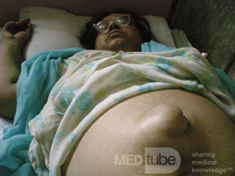Large Umblical Hernia