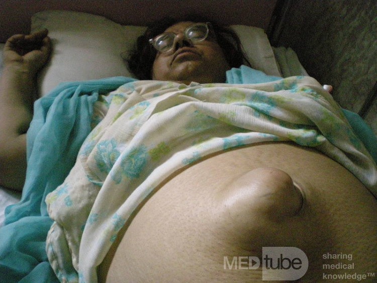 Large Umblical Hernia
