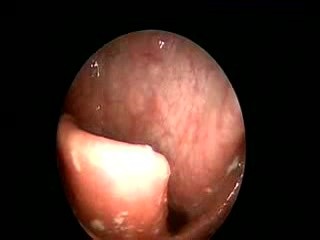 Oral Manifestation Of Aids 