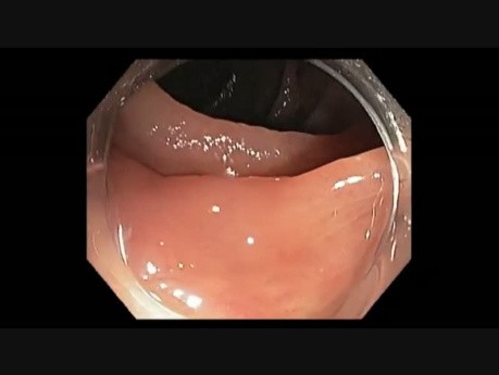 Colonoscopy Channel - How To Find A Subtle Flat Lesion