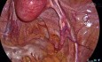 Total Laparoscopic Hysterectomy - Retroperitoneal Dissection Explained by Dr. Kunal Rathod