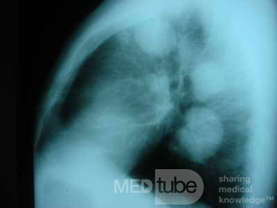 Endoscopy of rectal adenocarcinoma and internal
 hemorrhoids (4 of 10)
