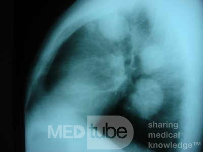 Endoscopy of rectal adenocarcinoma and internal
 hemorrhoids (4 of 10)