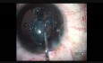 Plasma Blade Capsulotomy in Subluxated Cataract
