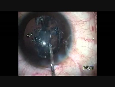 Plasma Blade Capsulotomy in Subluxated Cataract