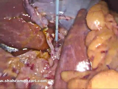 Ventral Ectopic Gallbladder Over the Hepatic Duct with Dual Cystic Arteries Intraoperative Identification and Strategy